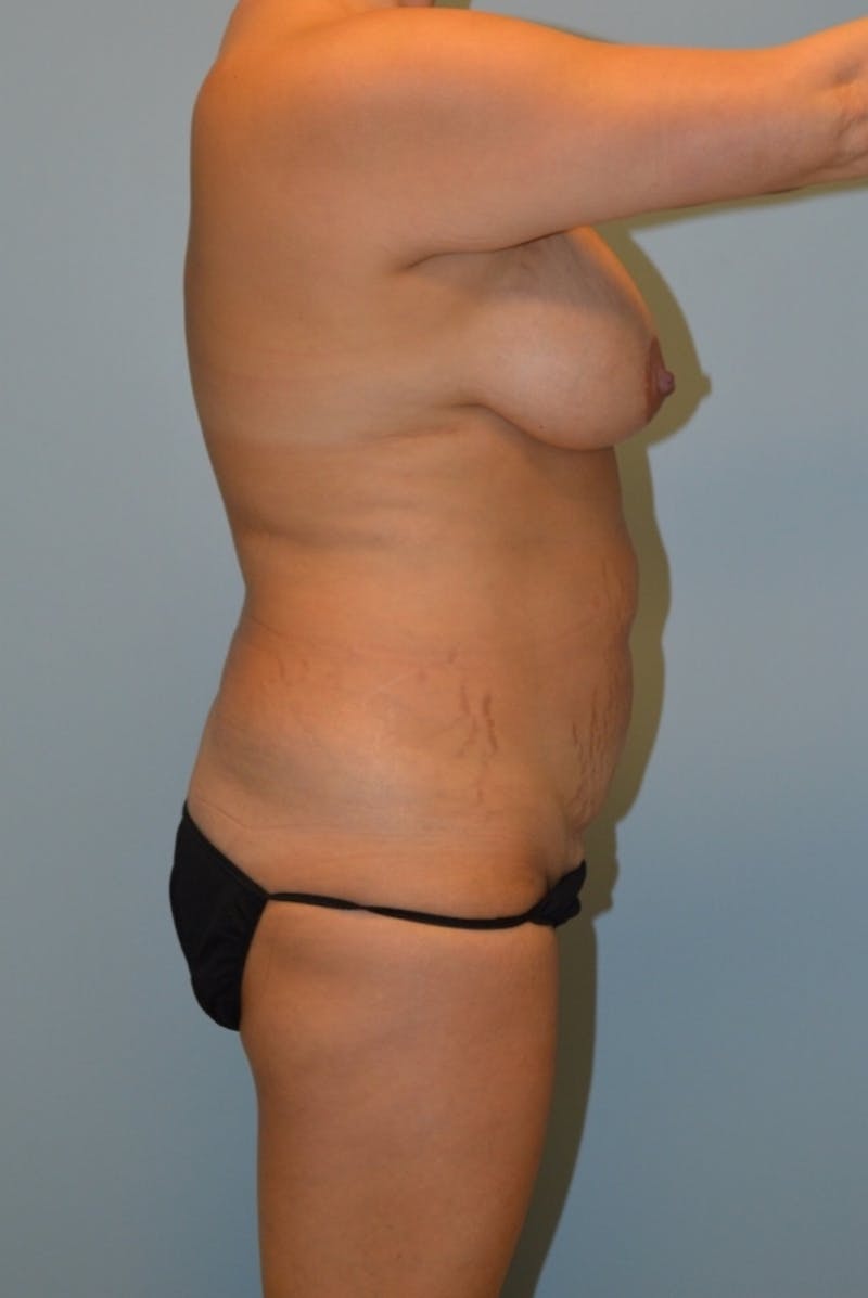 Brazilian Butt Lift Before & After Gallery - Patient 186519 - Image 3