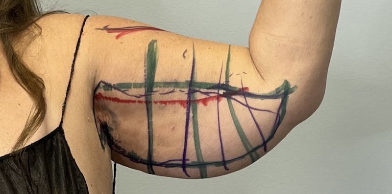 Arm Lift (Scarless Arm Lift) Before & After Gallery - Patient 203515 - Image 3