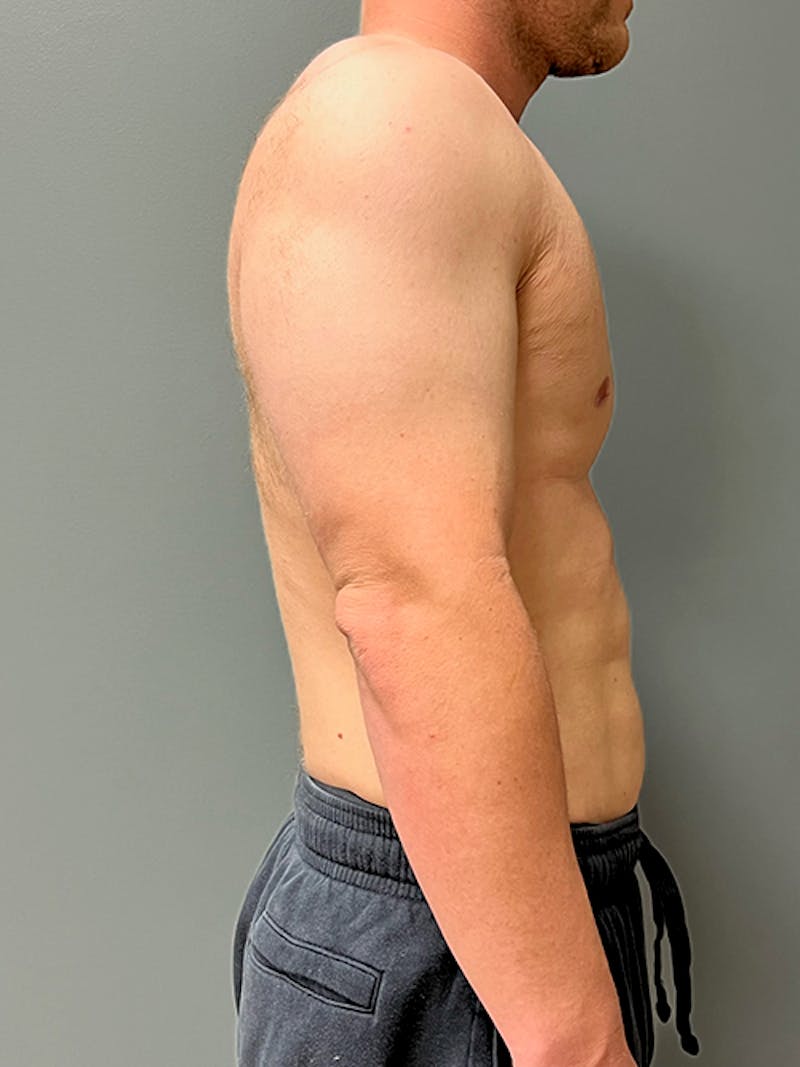 High Definition Men Before & After Gallery - Patient 839422 - Image 6