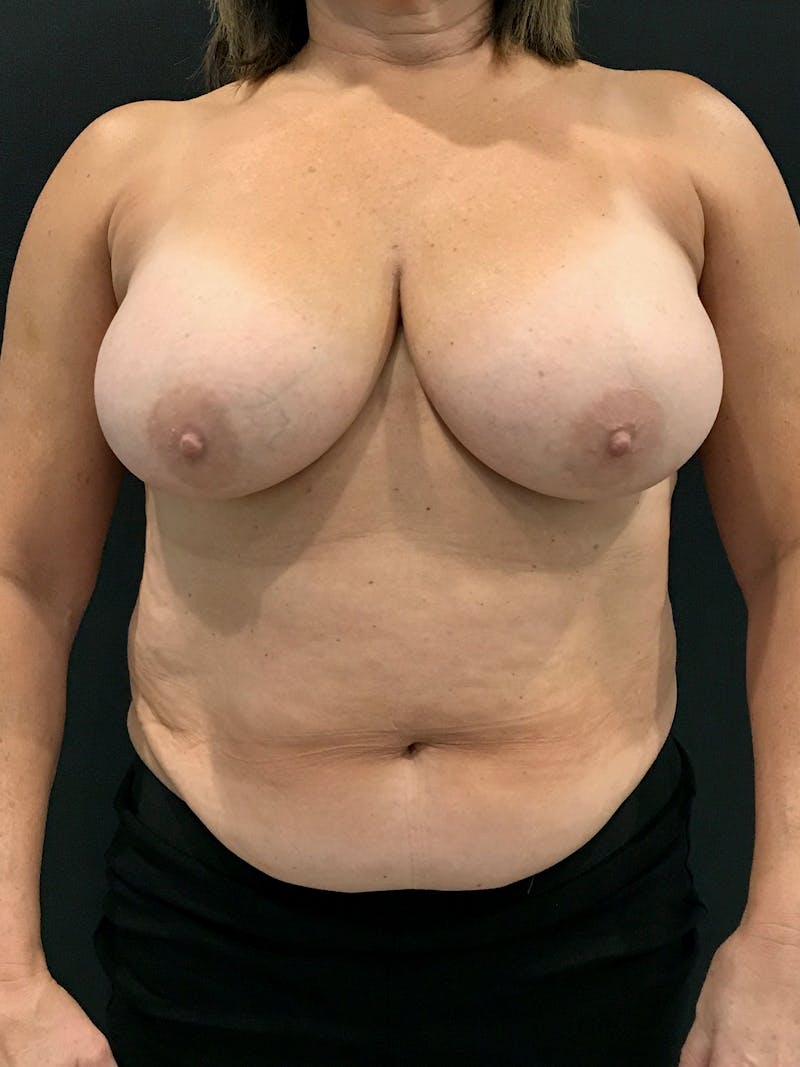 Breast Reduction Before & After Gallery - Patient 297096 - Image 1