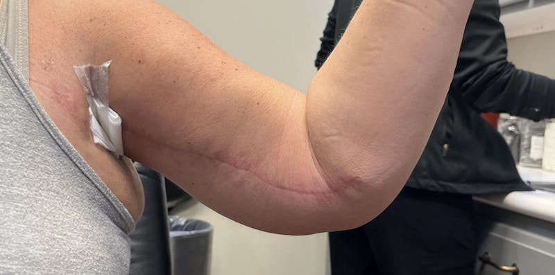 Arm Lift (Scarless Arm Lift) Before & After Gallery - Patient 203515 - Image 4