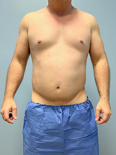 High Definition Men Before & After Gallery - Patient 387416 - Image 1