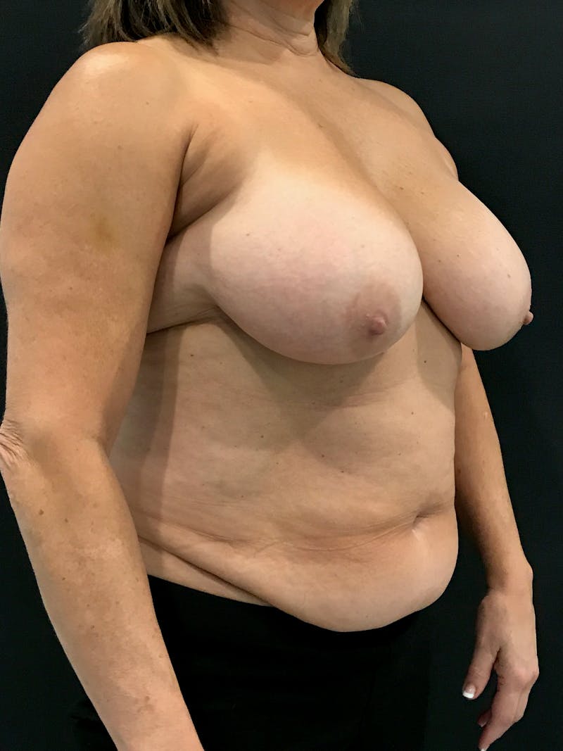 Breast Reduction Before & After Gallery - Patient 297096 - Image 3