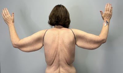 Arm Lift (Scarless Arm Lift) Before & After Gallery - Patient 387873 - Image 1