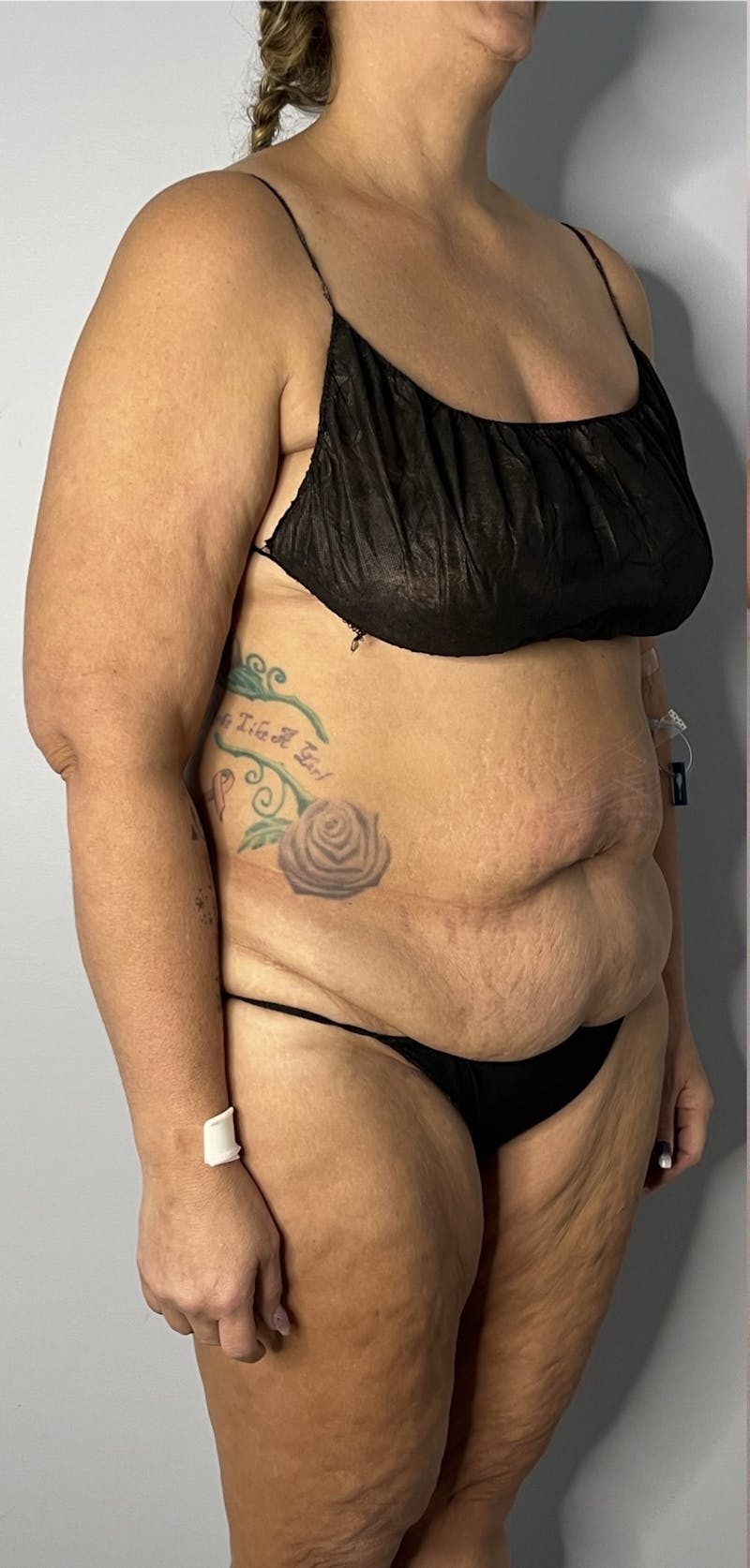 Liposuction Before & After Gallery - Patient 396508 - Image 3