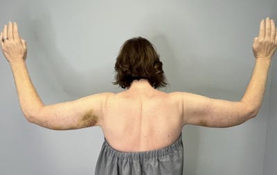 Arm Lift (Scarless Arm Lift) Before & After Gallery - Patient 387873 - Image 2