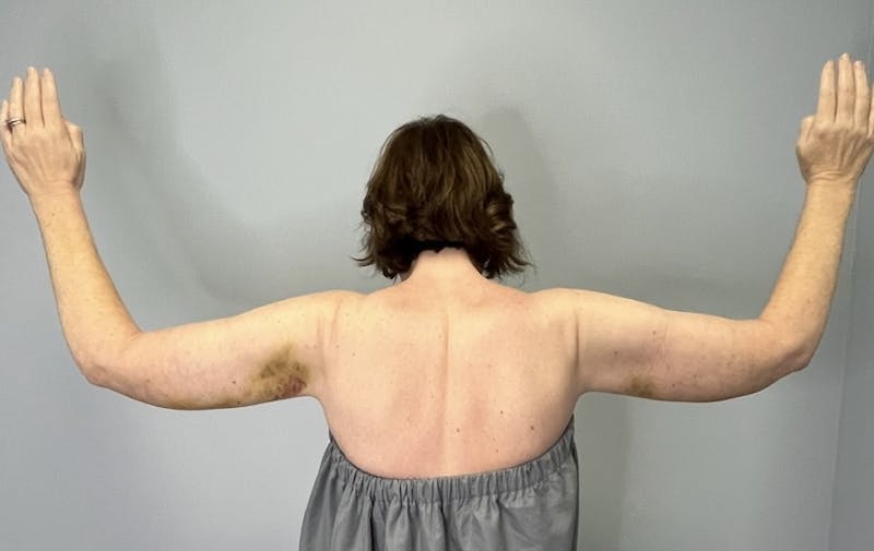 Arm Lift (Scarless Arm Lift) Before & After Gallery - Patient 387873 - Image 2