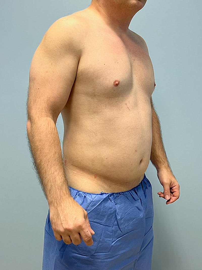 High Definition Men Before & After Gallery - Patient 387416 - Image 3