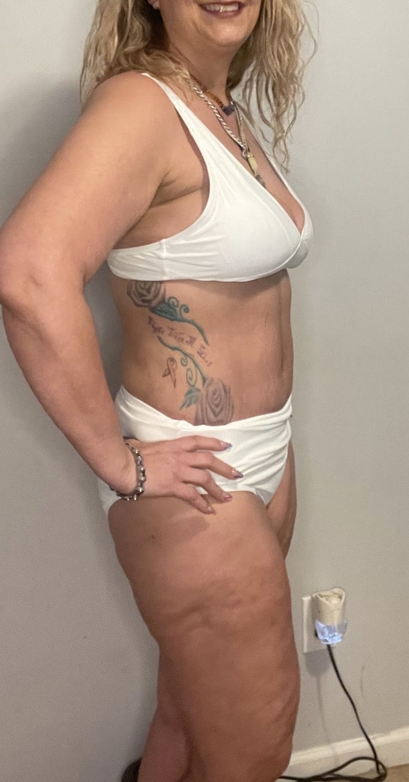 Liposuction Before & After Gallery - Patient 396508 - Image 4