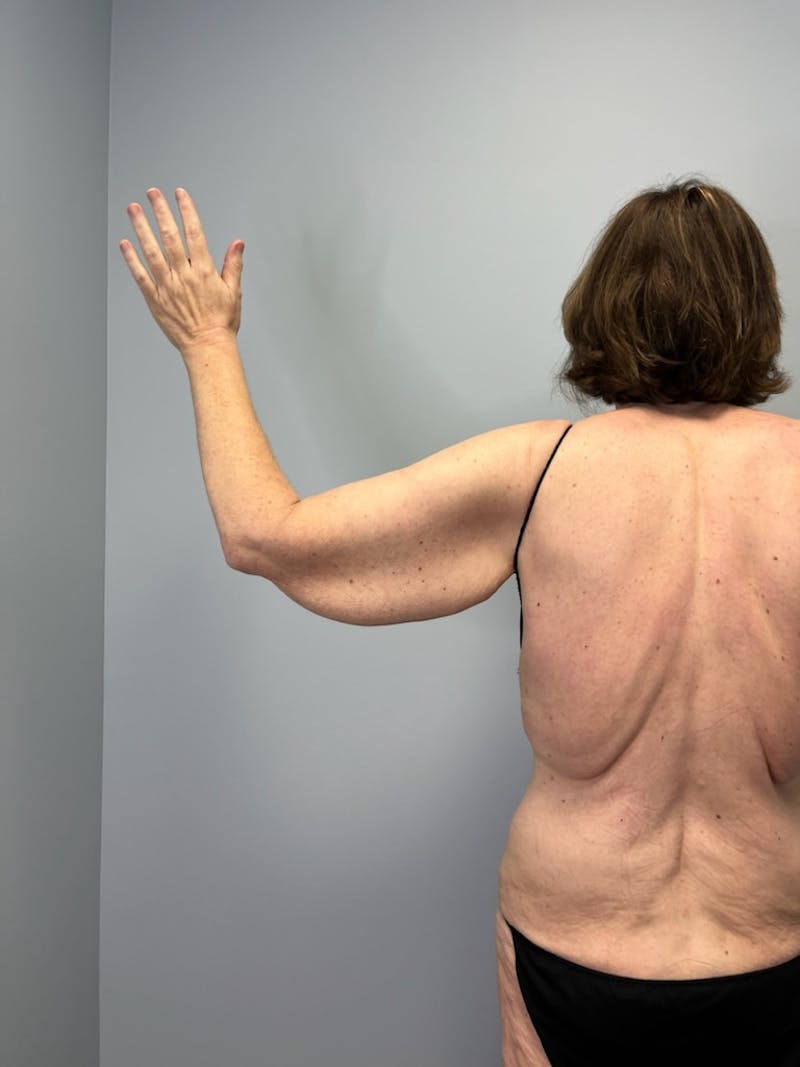 Arm Lift (Scarless Arm Lift) Before & After Gallery - Patient 387873 - Image 3