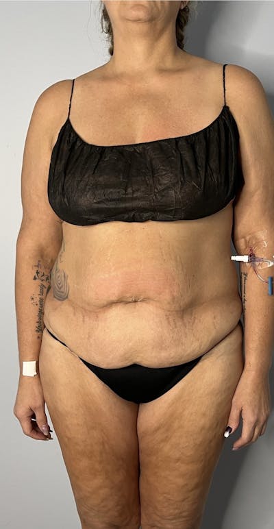 Tummy Tuck Before & After Gallery - Patient 313751 - Image 1