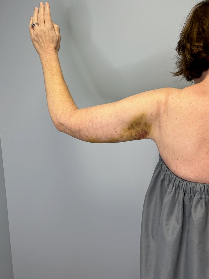Arm Lift (Scarless Arm Lift) Before & After Gallery - Patient 387873 - Image 4