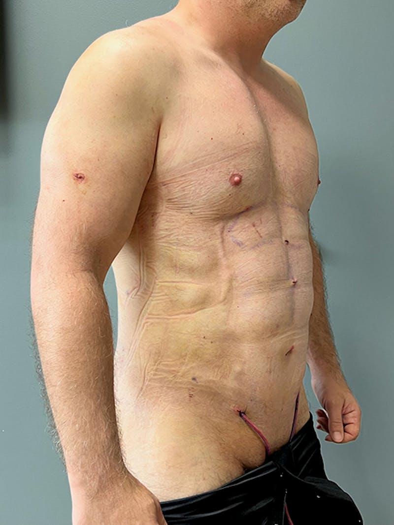 High Definition Men Before & After Gallery - Patient 387416 - Image 4
