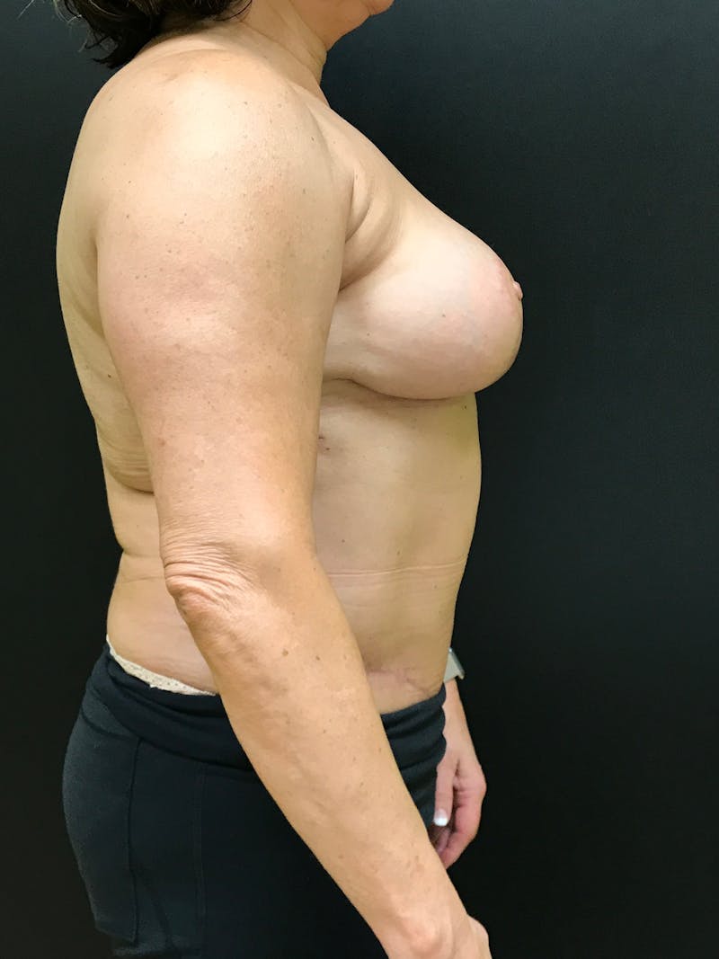 Breast Reduction Before & After Gallery - Patient 297096 - Image 6