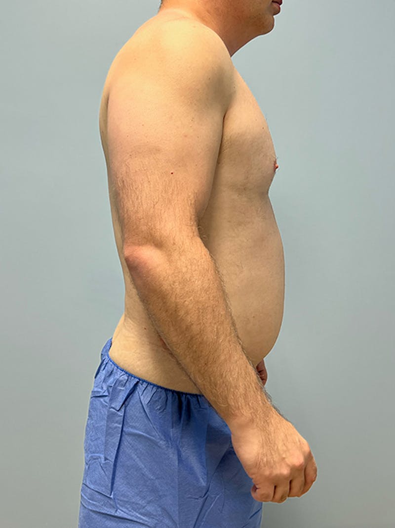 High Definition Men Before & After Gallery - Patient 387416 - Image 5