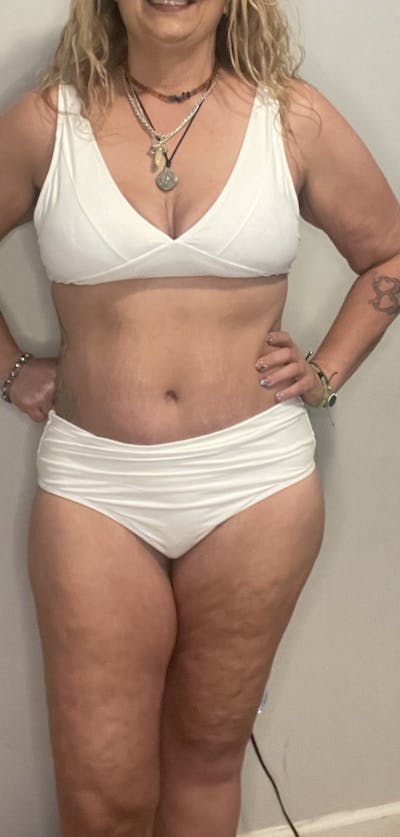 Tummy Tuck Before & After Gallery - Patient 313751 - Image 2