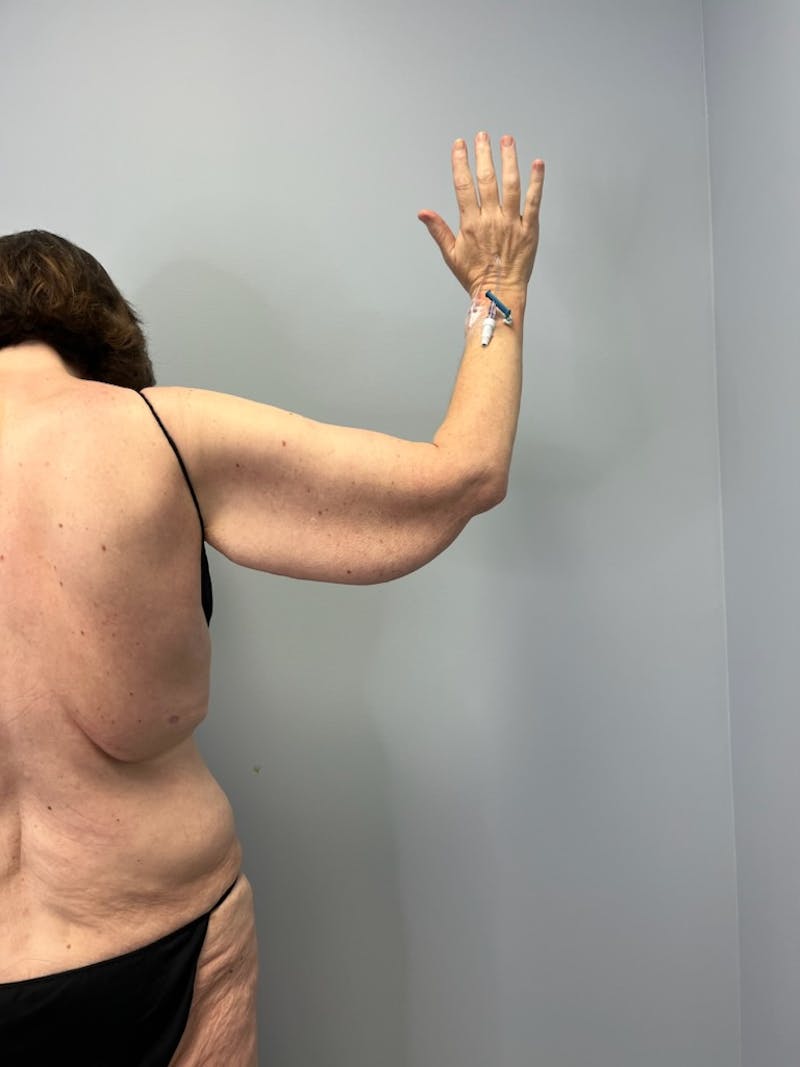 Arm Lift (Scarless Arm Lift) Before & After Gallery - Patient 387873 - Image 5
