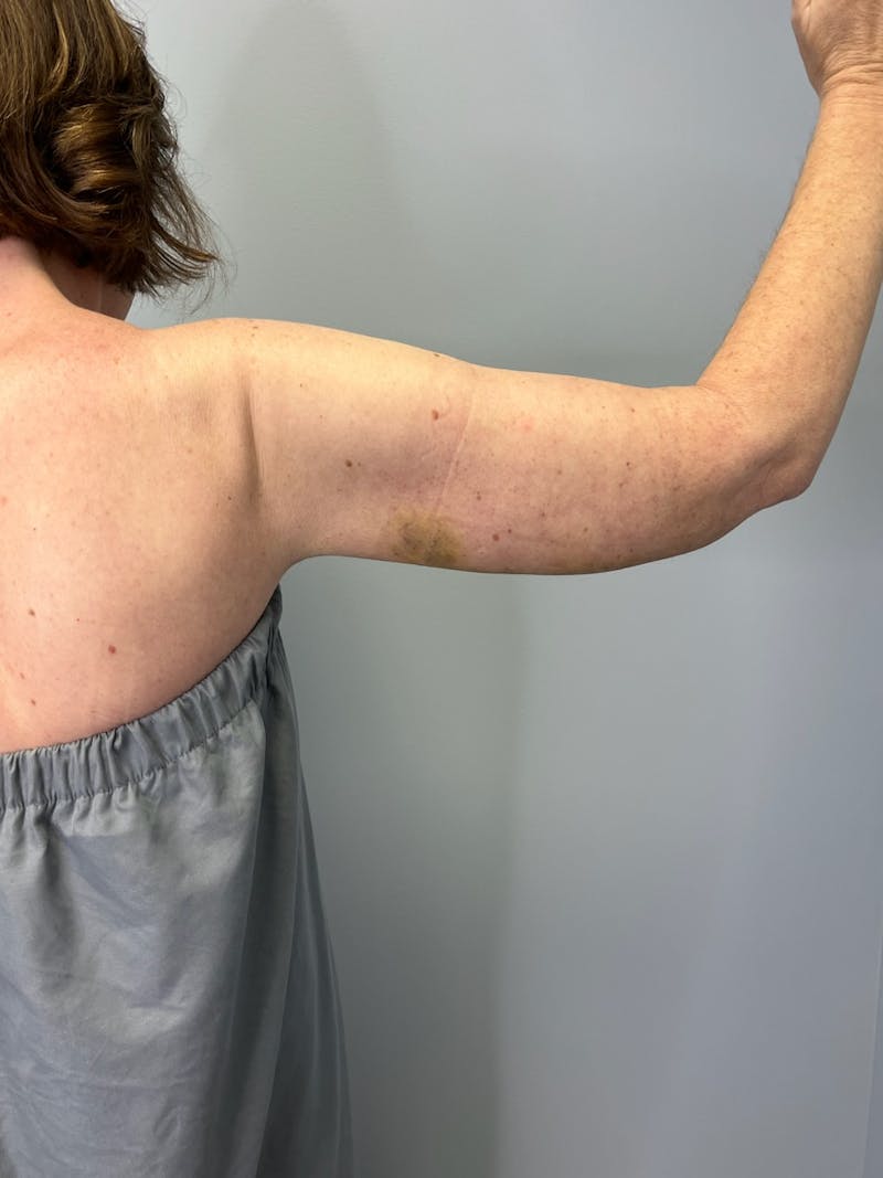 Arm Lift (Scarless Arm Lift) Before & After Gallery - Patient 387873 - Image 6