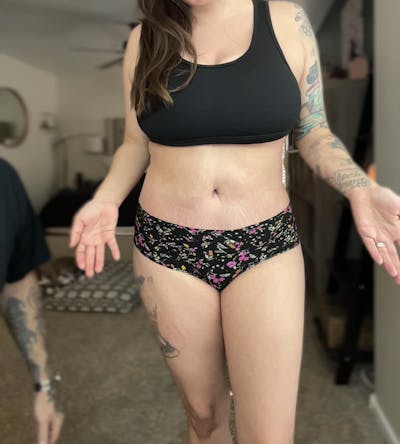 Liposuction Before & After Gallery - Patient 227095 - Image 2