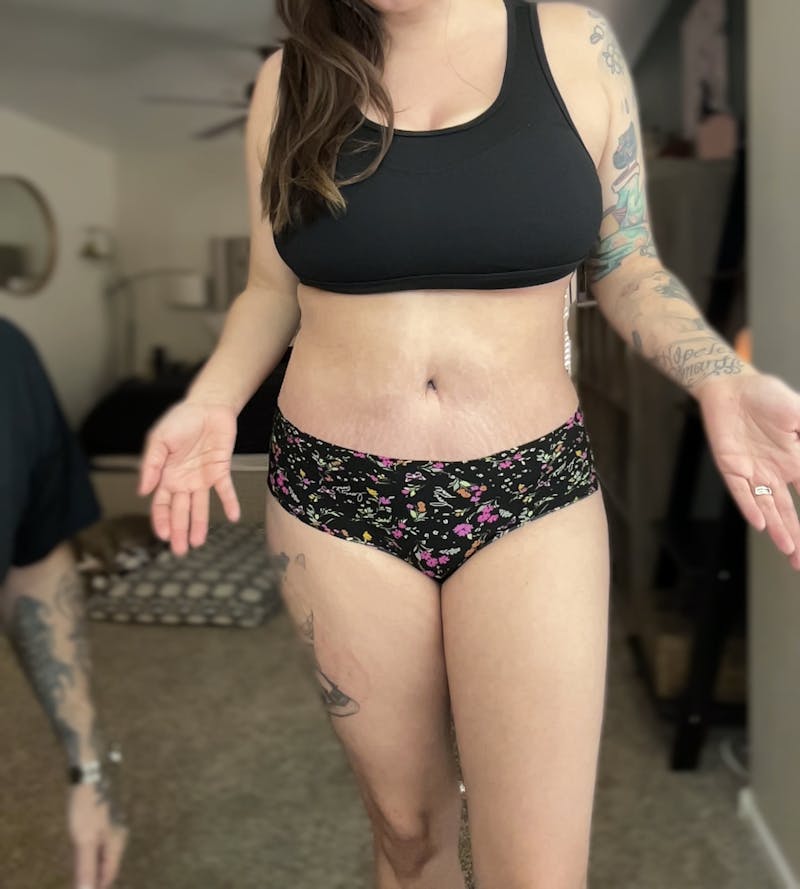 Liposuction Before & After Gallery - Patient 227095 - Image 2