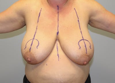 Breast Reduction Before & After Gallery - Patient 489768 - Image 1