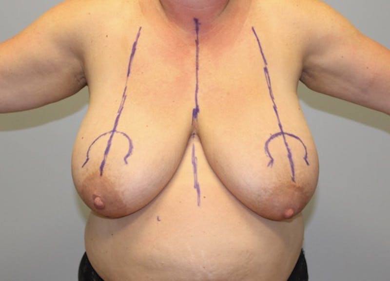 Breast Reduction Before & After Gallery - Patient 489768 - Image 1