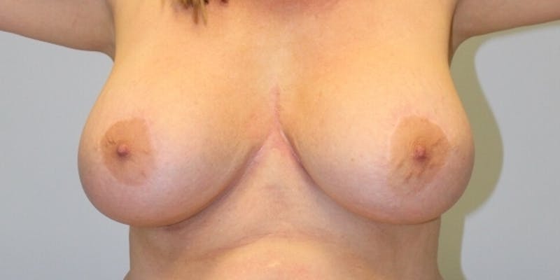 Breast Lift Before & After Gallery - Patient 402674 - Image 3