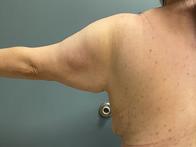 Arm Lift (Scarless Arm Lift) Before & After Gallery - Patient 159009 - Image 1