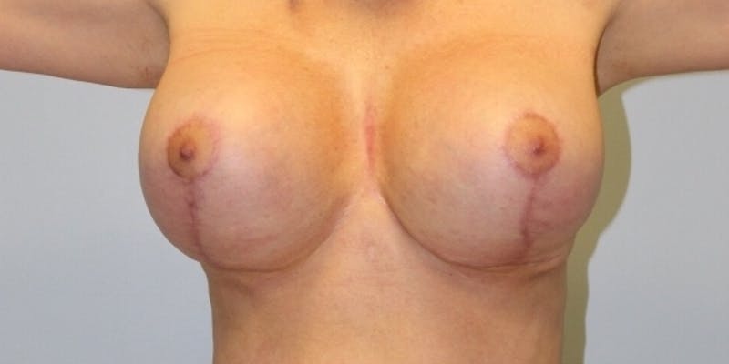 Breast Lift Before & After Gallery - Patient 402674 - Image 4