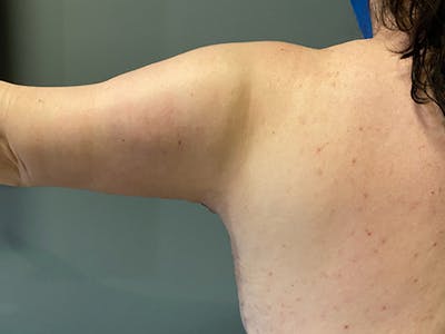 Arm Lift (Scarless Arm Lift) Before & After Gallery - Patient 159009 - Image 2