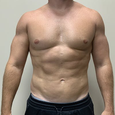 High Definition Men Before & After Gallery - Patient 204402 - Image 2