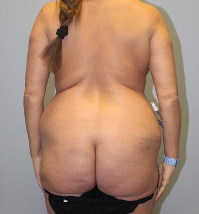 Brazilian Butt Lift Before & After Gallery - Patient 604218 - Image 1