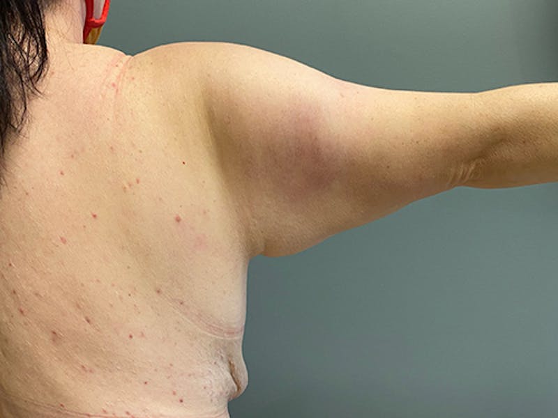 Arm Lift (Scarless Arm Lift) Before & After Gallery - Patient 159009 - Image 3