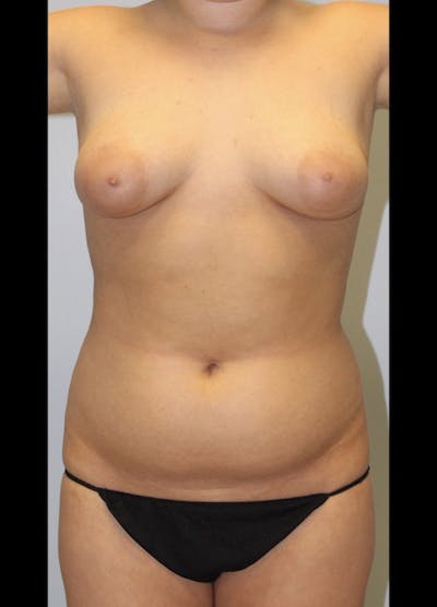 Liposuction Before & After Gallery - Patient 208357 - Image 1