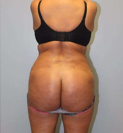 Brazilian Butt Lift Before & After Gallery - Patient 604218 - Image 2