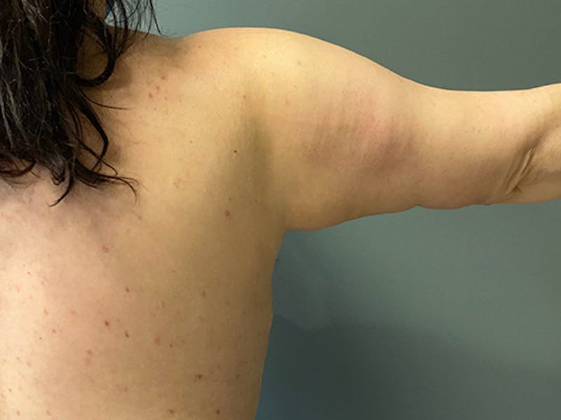 Arm Lift (Scarless Arm Lift) Before & After Gallery - Patient 159009 - Image 4