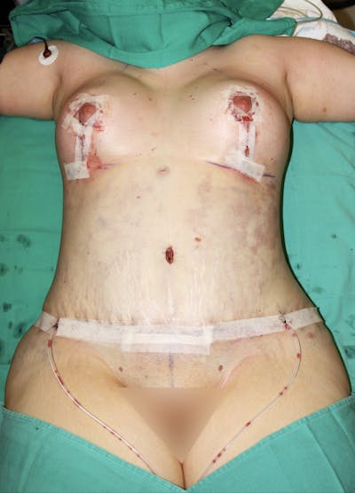 Liposuction Before & After Gallery - Patient 208357 - Image 2