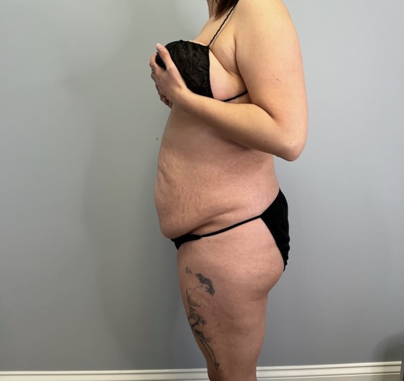 Tummy Tuck Before & After Gallery - Patient 246105 - Image 3