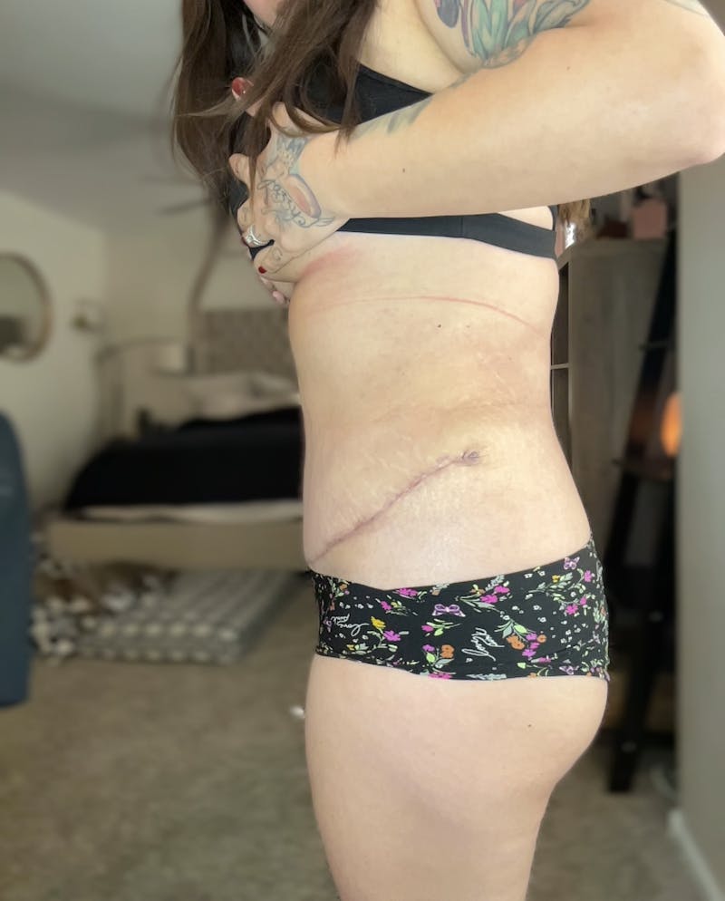 Tummy Tuck Before & After Gallery - Patient 246105 - Image 4