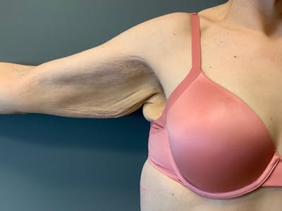 Arm Lift (Scarless Arm Lift) Before & After Gallery - Patient 994810 - Image 1