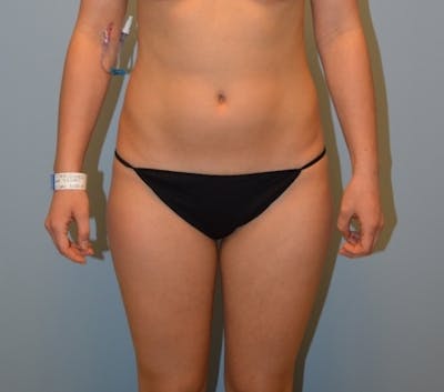 Liposuction Before & After Gallery - Patient 290680 - Image 1