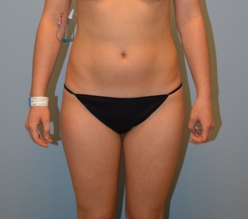 Liposuction Before & After Gallery - Patient 290680 - Image 1