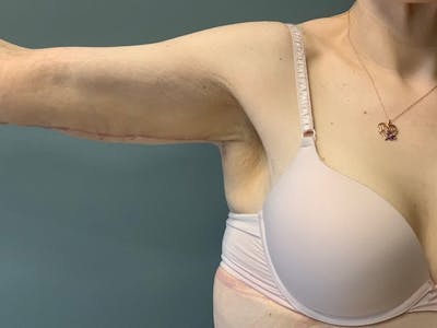 Arm Lift (Scarless Arm Lift) Before & After Gallery - Patient 994810 - Image 2
