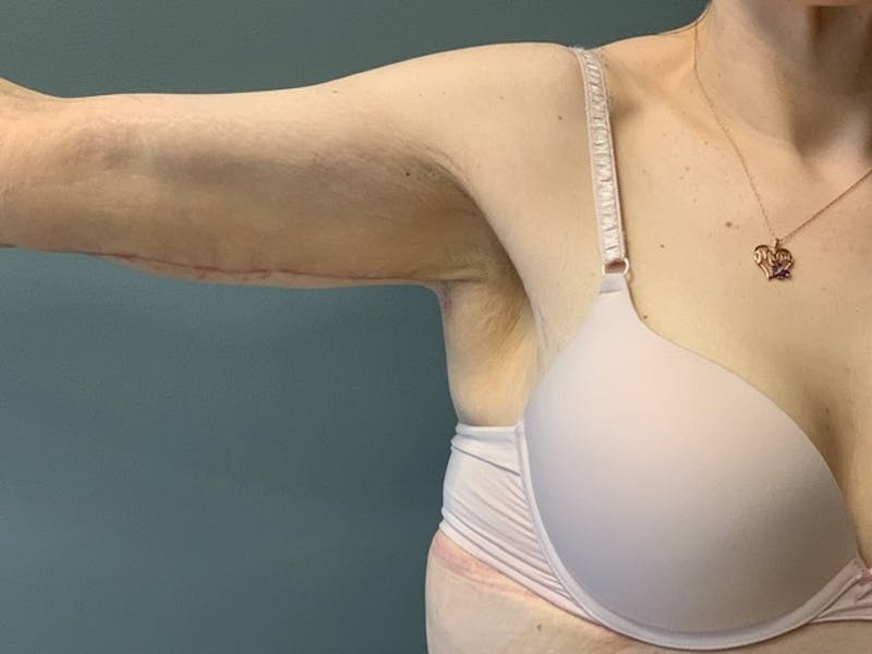 Arm Lift (Scarless Arm Lift) Before & After Gallery - Patient 994810 - Image 2