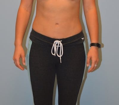 Liposuction Before & After Gallery - Patient 290680 - Image 2