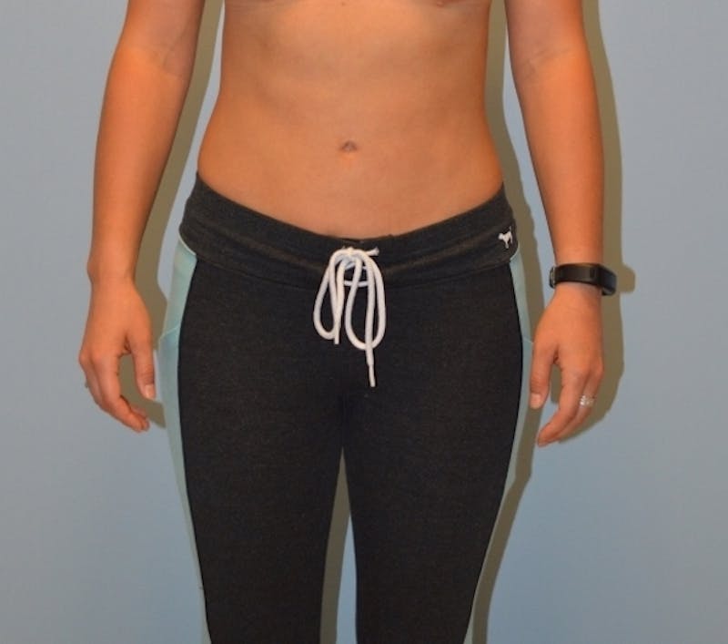 Liposuction Before & After Gallery - Patient 290680 - Image 2