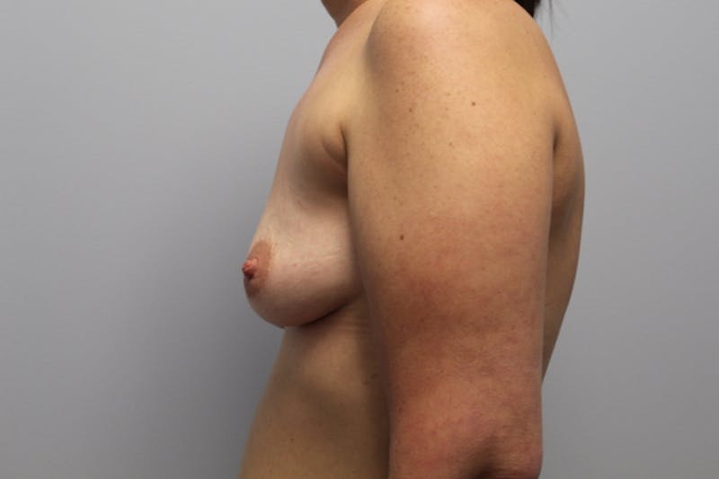 Corrective Breast Procedures Before & After Gallery - Patient 934476 - Image 9