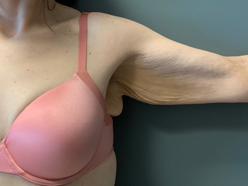 Arm Lift (Scarless Arm Lift) Before & After Gallery - Patient 994810 - Image 3