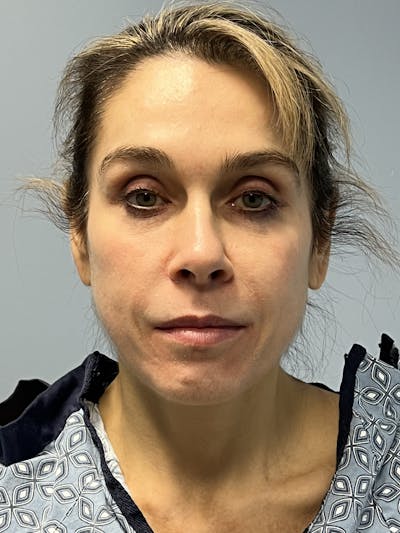 Facial Rejuvenation Before & After Gallery - Patient 165474 - Image 1