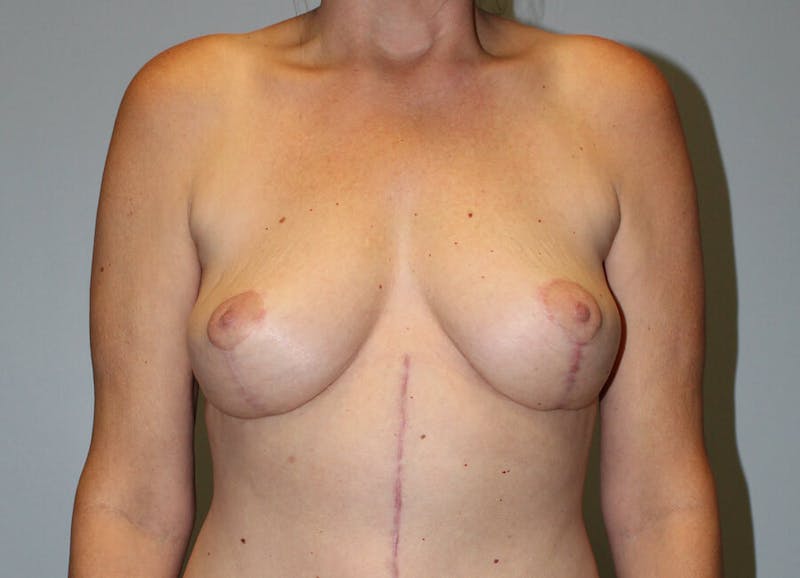 Breast Lift Before & After Gallery - Patient 214858 - Image 6